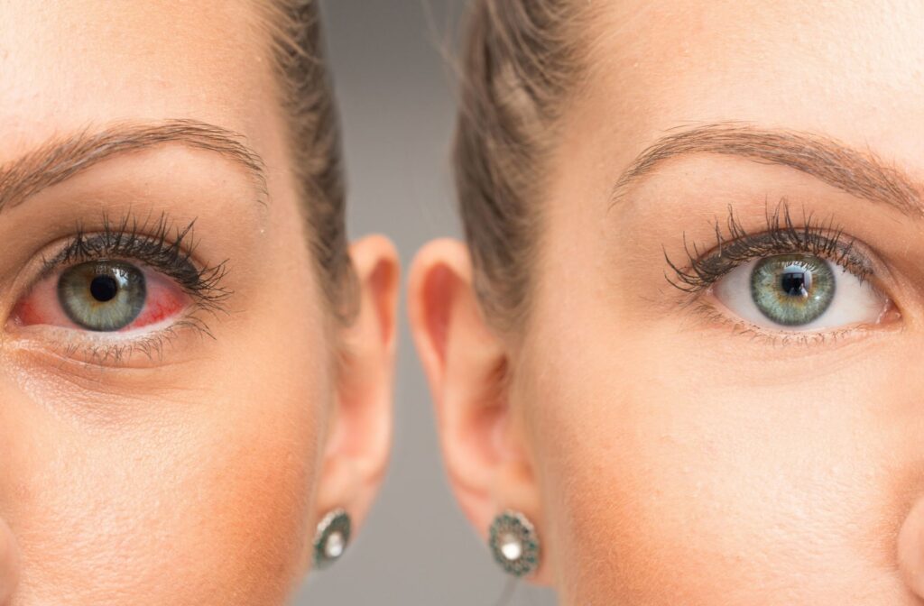 A comparison of a woman's normal, healthy eye with woman's dry eye.