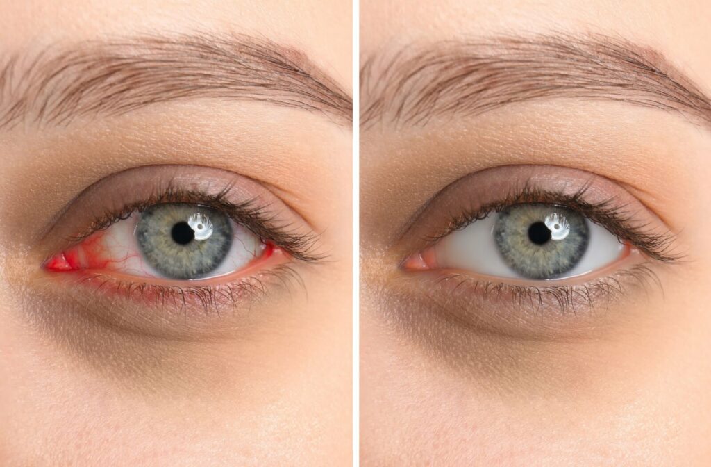 A before and after image of an eye with clogged meibomian glands and the eye after symptoms are relieved