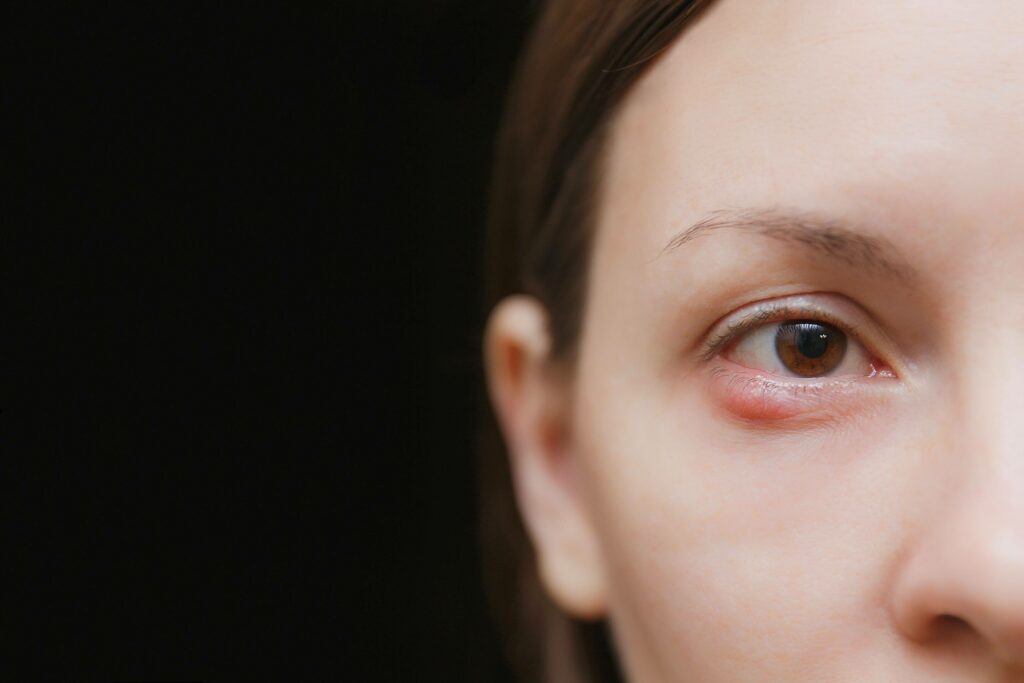 Close-up of an irritated eye showing redness near the lower eyelid, commonly associated with meibomian gland blockage.